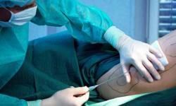 A woman undergoing liposuction