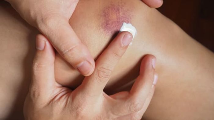 A person applying a bandage to a bruised knee.