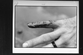 A finger injured by a piranha bite.