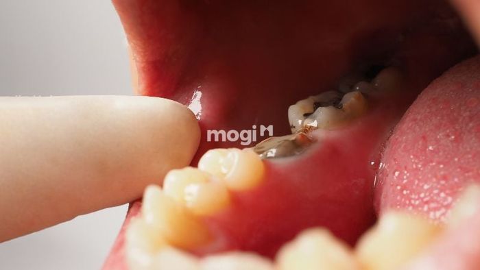 Giấc mơ về việc gãy răng mang đến điềm báo gì?