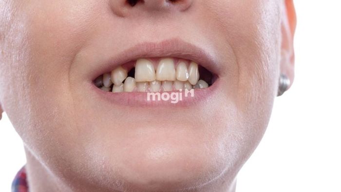 Mơ thấy gãy răng nhưng không chảy máu