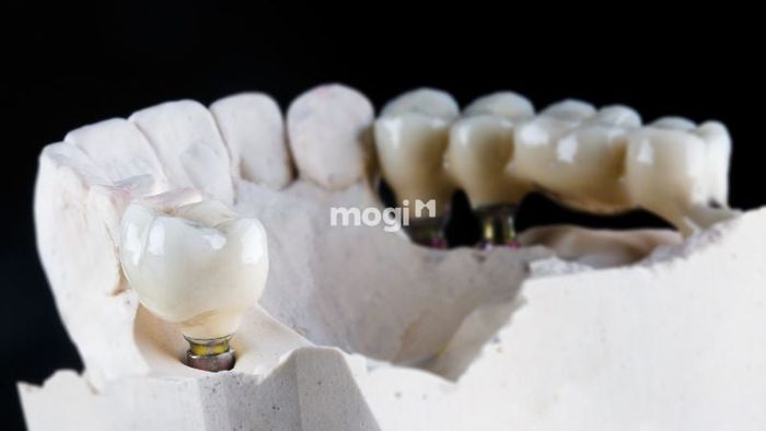 Mơ thấy răng giả bị gãy có thể là dấu hiệu báo trước về những khó khăn đang dần tan biến và thành công sẽ đến với bạn trong tương lai gần. Đây là thời điểm thích hợp để bạn tự tin vào những quyết định của mình.