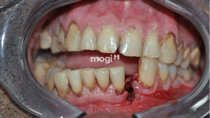 Mơ thấy răng hàm dưới bị gãy có thể là dấu hiệu cảnh báo về những khó khăn mà bạn đang gặp phải trong cuộc sống. Đây là lời nhắc nhở bạn cần chú ý đến các vấn đề xung quanh để tránh những tổn thất không đáng có.