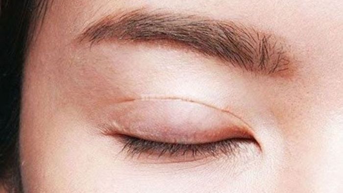 Các tai nạn trong quá trình phẫu thuật thẩm mỹ có thể làm ảnh hưởng đến cơ nâng mi, gây ra tình trạng sụp mí.