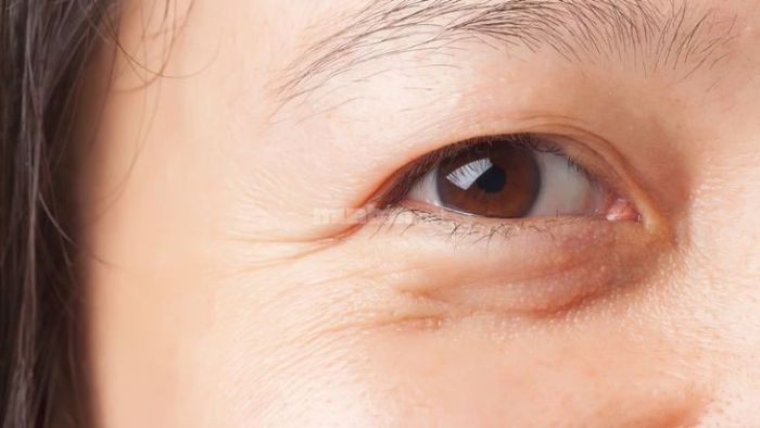 Chế độ ngủ có thể ảnh hưởng đáng kể đến cấu trúc của mí mắt.