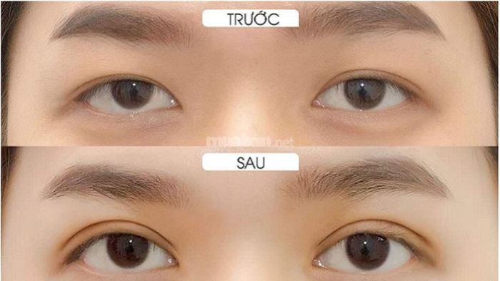 Cắt mí là phương pháp giúp duy trì hiệu quả lâu dài nếu được chăm sóc đúng cách.