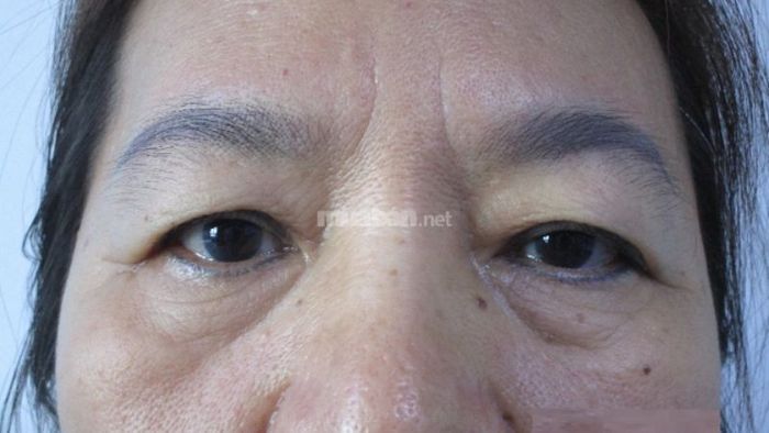 Mắt một mí có thể hình thành do quá trình lão hóa.