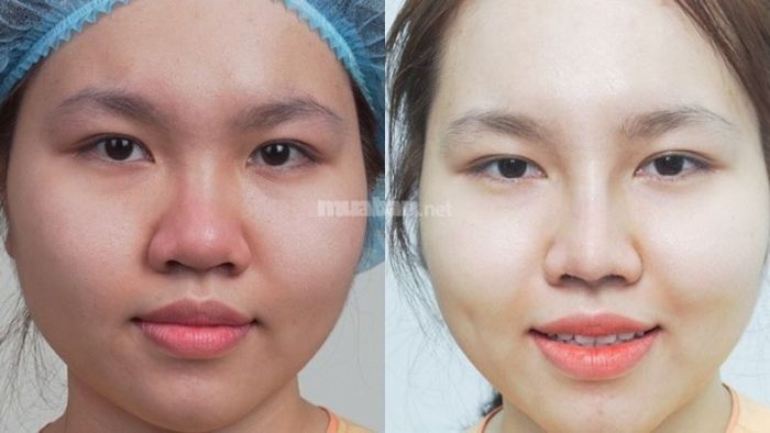 Nếu bạn cảm thấy không tự tin với dáng mũi củ tỏi, bạn có thể xem xét các phương pháp thẩm mỹ để cải thiện.