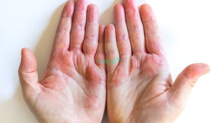 Nguyên nhân ngứa lòng bàn tay phải là gì?