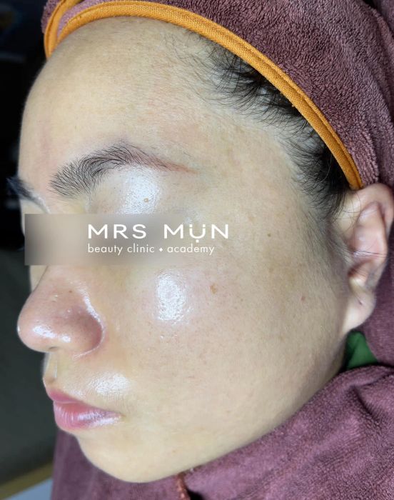 Hình ảnh thực tế về quy trình điều trị tại Mrs Mụn Beauty Clinic & Academy