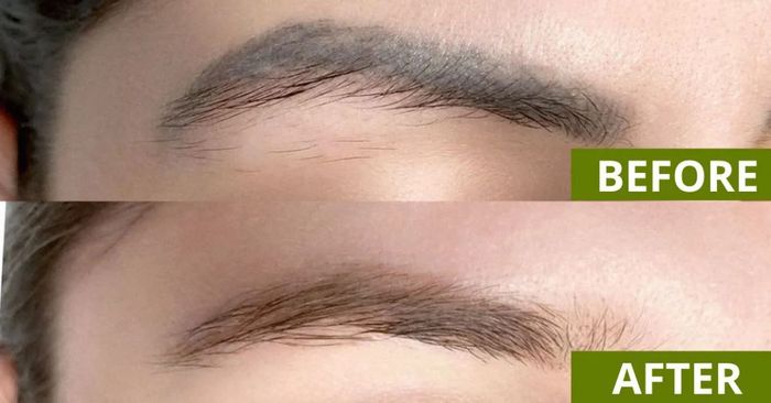 Hình ảnh thực tế quy trình xóa xăm tại Thanh Thư Beauty Spa
