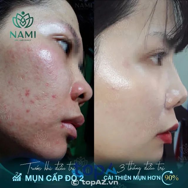 Địa chỉ spa trị mụn Hải Phòng đạt chuẩn y khoa