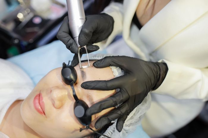 Hình ảnh thực tế quy trình xóa xăm tại Thanh Thien Beauty House
