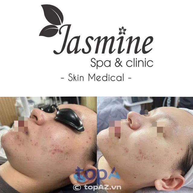 Địa chỉ vàng trong làng spa trị mụn Hải Phòng được giới sành điệu tin chọn