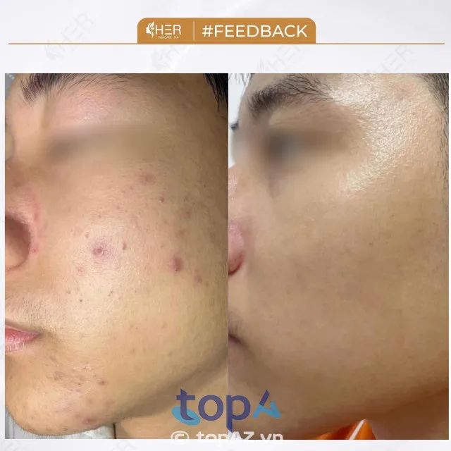 Top spa trị mụn Hải Phòng được giới chuyên gia đánh giá cao