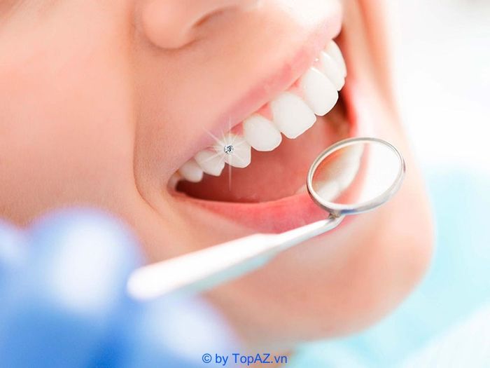 dịch vụ đính đá lên răng đẹp tại TPHCM