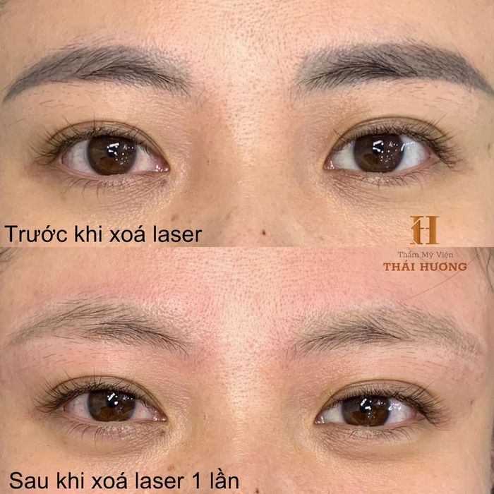 Hình ảnh thực tế quy trình xóa xăm tại Thẩm Mỹ Viện Thái Hương