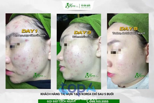 Địa chỉ spa trị mụn Hải Phòng được hàng ngàn khách hàng tin tưởng
