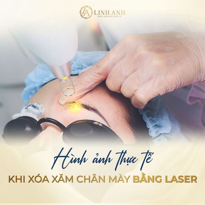 Hình ảnh thực tế quy trình xóa xăm bằng công nghệ cao tại Linh Anh