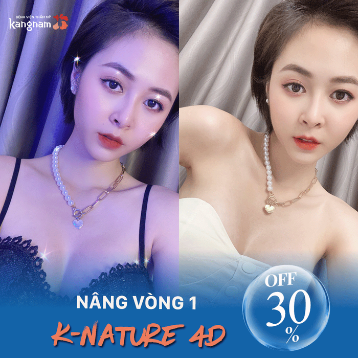 Hình ảnh thực tế về kết quả nâng ngực tại Kangnam