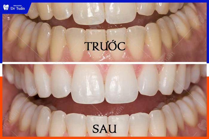Hình ảnh quy trình tẩy trắng chuẩn y khoa tại Nha Khoa Dr. Tuấn Nhà Thờ