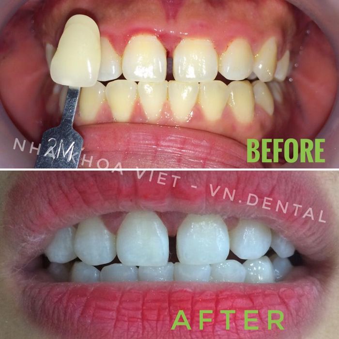 Quy trình tẩy trắng răng chuẩn y khoa tại Nha Khoa Việt Plus