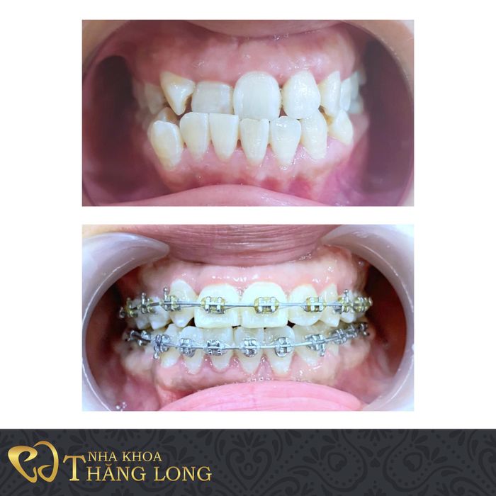 Hình ảnh quy trình niềng răng chuyên nghiệp tại Nha Khoa Thăng Long