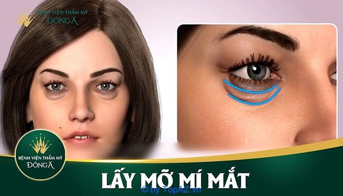Địa chỉ lấy mỡ bọng mắt uy tín tại TP.HCM - Tìm kiếm nơi đẹp an toàn và hiệu quả
