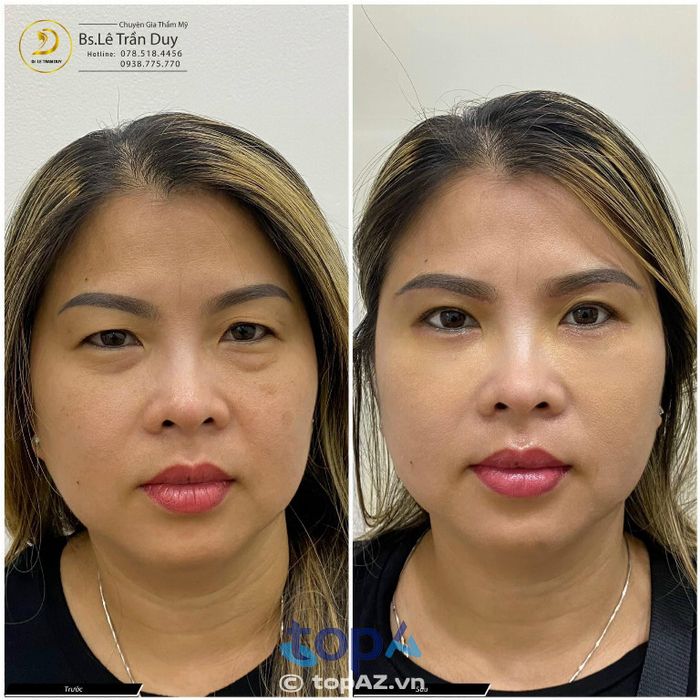 địa chỉ lấy mỡ bọng mắt chất lượng tại tphcm