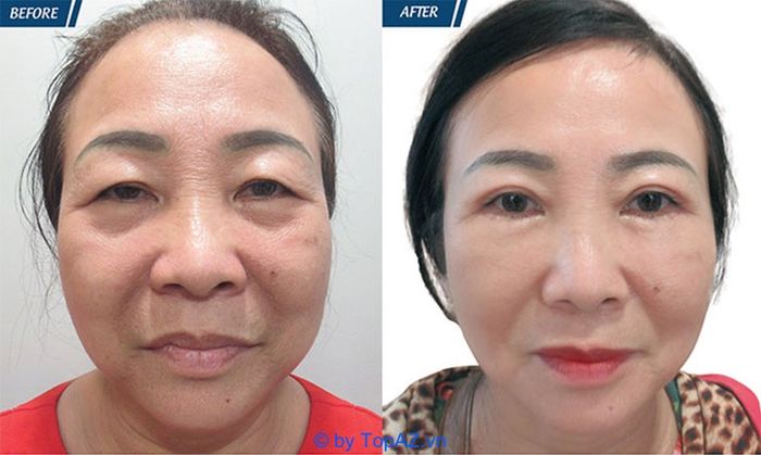 Địa chỉ lấy mỡ bọng mắt uy tín hàng đầu tại TP.HCM