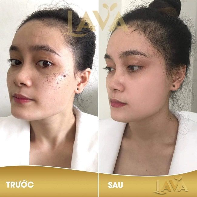 Thẩm mỹ viện LAVA - Tiên phong công nghệ trị nám không xâm lấn