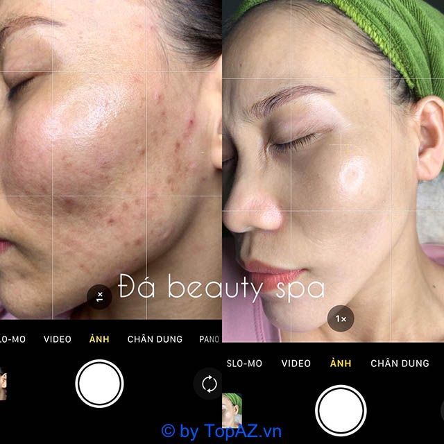 Địa chỉ spa trị mụn uy tín hàng đầu tại Quảng Ngãi