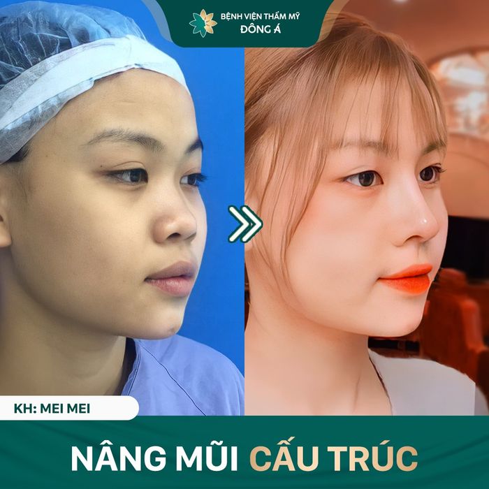 Hình ảnh thực tế kết quả nâng mũi công nghệ Nano Form