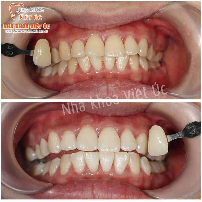 Hình ảnh thực tế tại Nha khoa Việt Úc