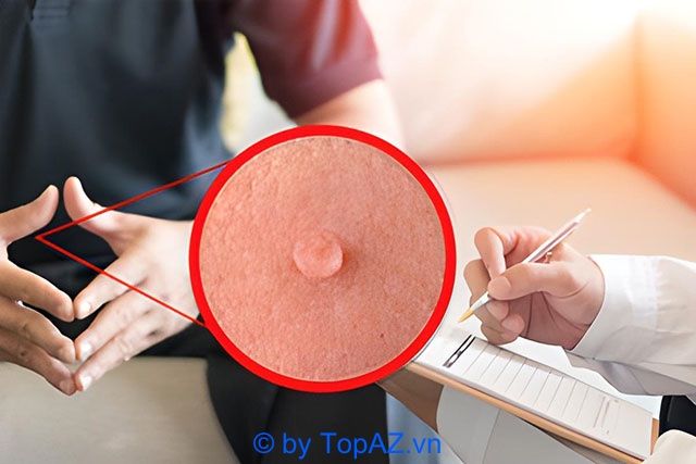 Địa chỉ vàng trong điều trị sùi mào gà tại TP.HCM