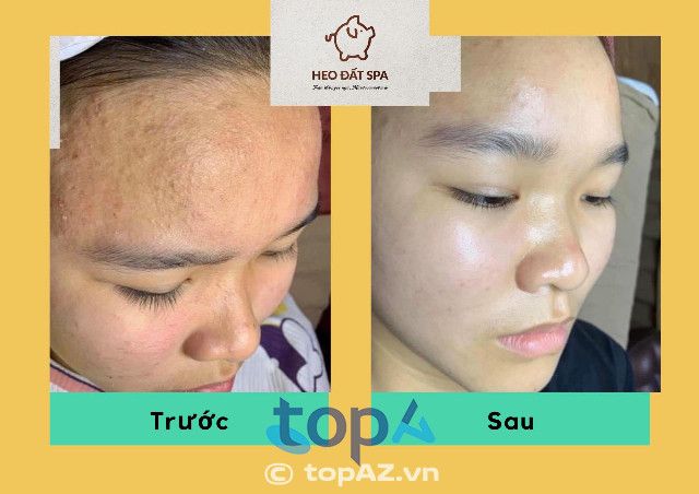 Spa Heo Đất - Địa chỉ vàng trong điều trị mụn chuyên sâu tại Châu Đức