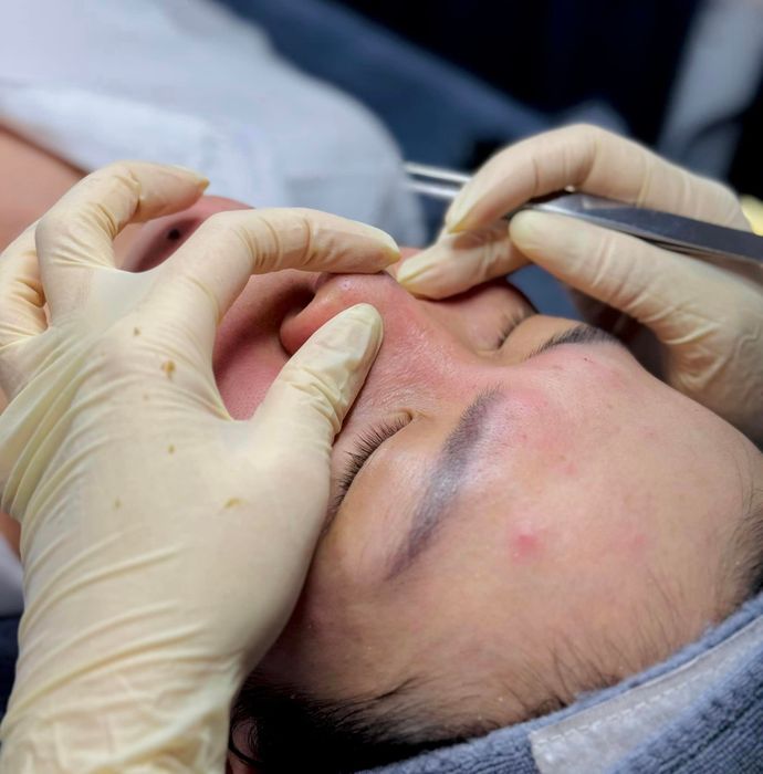 Hình ảnh minh họa quy trình trị mụn chuyên nghiệp (Nguồn: Rebi Beauty)