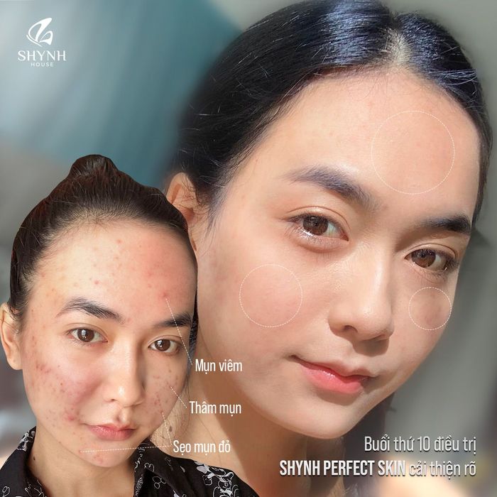 Shynh House - Hình ảnh 3: Công nghệ laser trị mụn đột phá