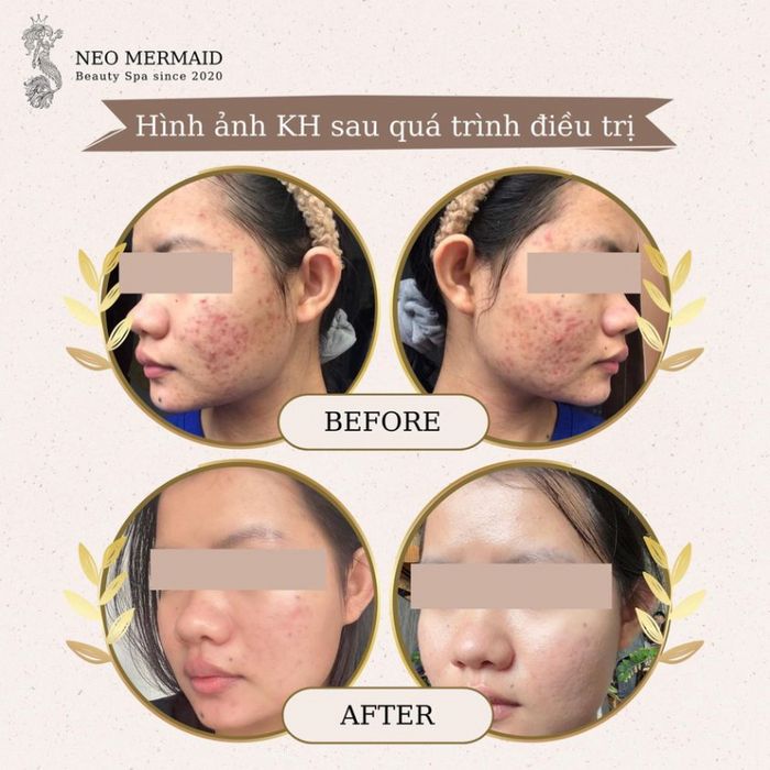 Neo Mermaid Beauty Spa - Hình ảnh 2: Công nghệ trị mụn đột phá
