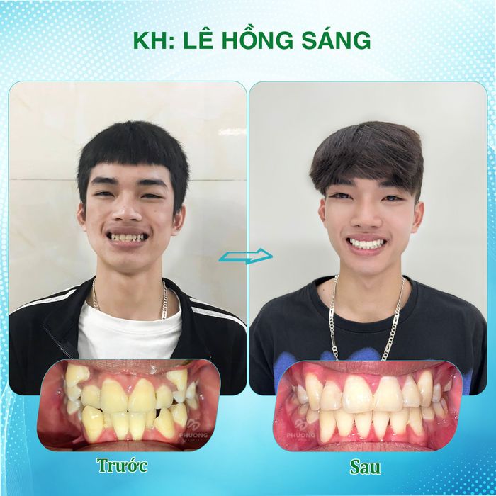 Quy trình niềng răng chuyên nghiệp tại Phương Dentist