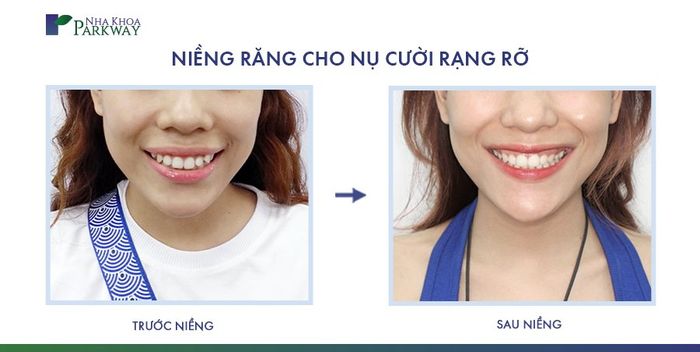 Quy trình niềng răng chuyên nghiệp tại Nha Khoa Parkway