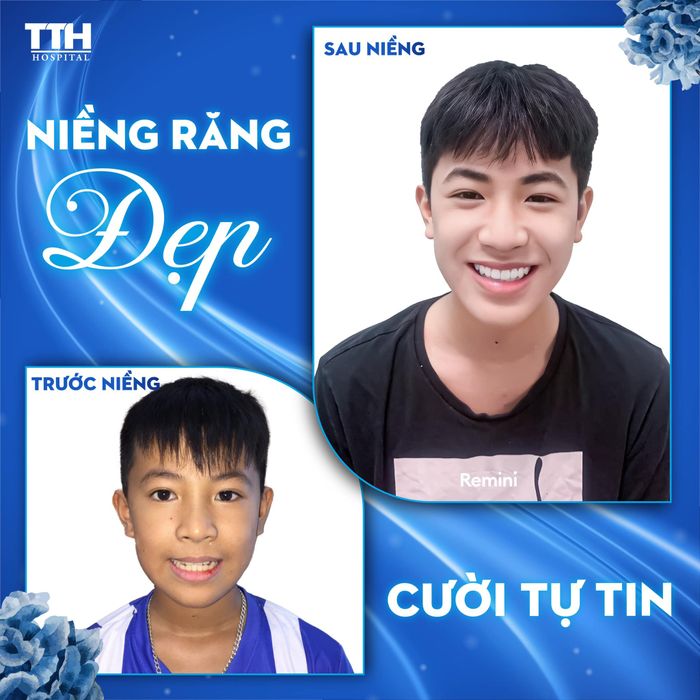 Quy trình niềng răng chuyên nghiệp tại Thái Thượng Hoàng
