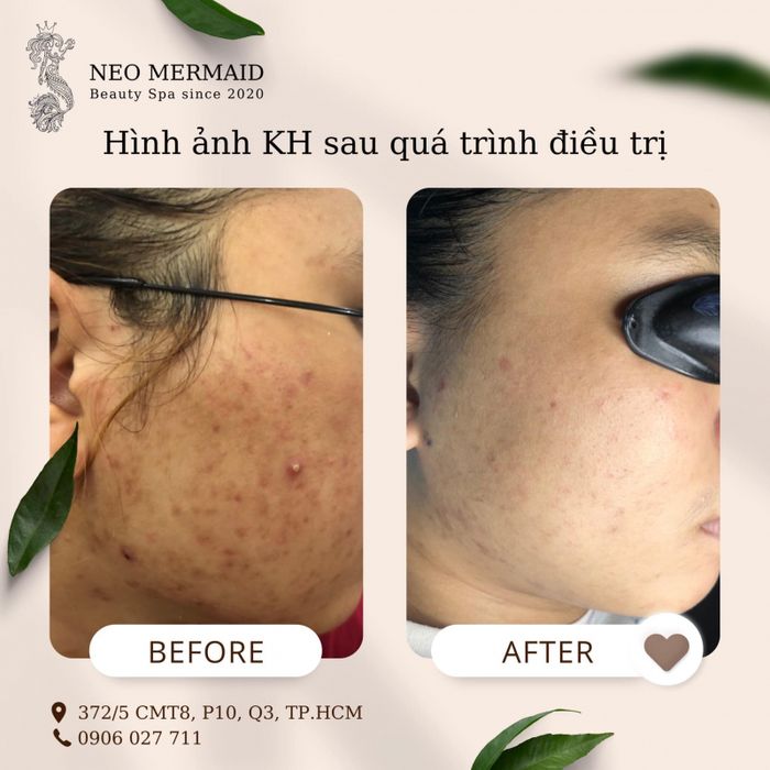 Neo Mermaid Beauty Spa - Hình ảnh 3: Kết quả da sáng mịn sau liệu trình