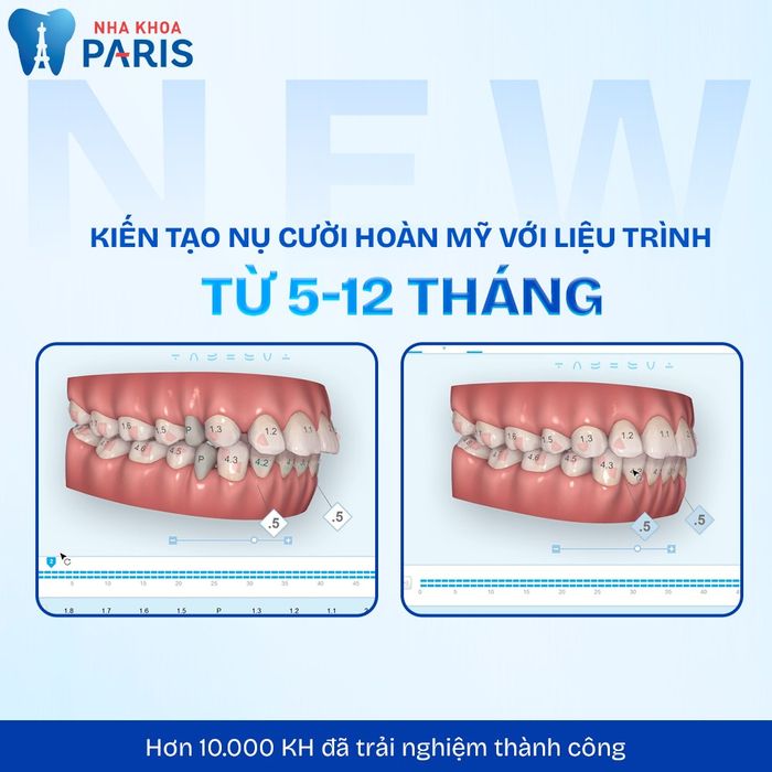 Hình ảnh thực tế về dịch vụ niềng răng tại Nha Khoa Paris Vinh