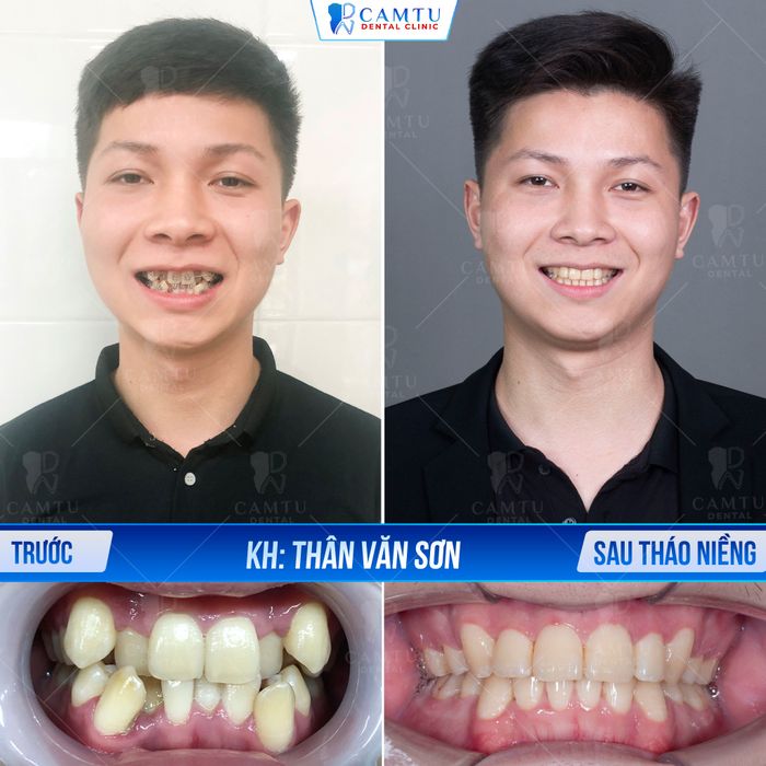 Quy trình niềng răng chuyên nghiệp tại Nha Khoa Cẩm Tú