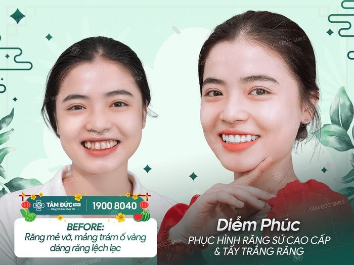 Hình ảnh công nghệ tẩy trắng Laser tại Nha Khoa Tâm Đức Smile