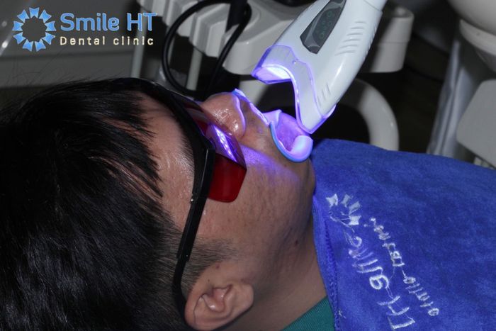 Hình ảnh thực tế quy trình tẩy trắng tại Nha Khoa Thẩm Mỹ Smile HT