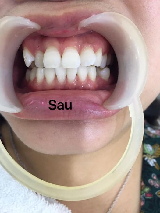Hình ảnh thực tế tại Nha Khoa Sài Gòn Smile