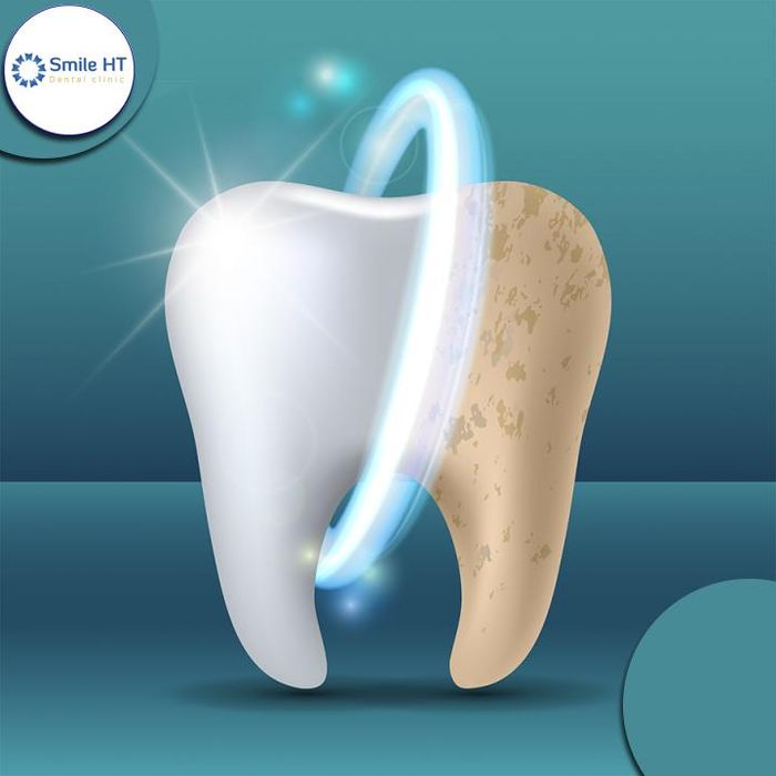 Hình ảnh kết quả tẩy trắng răng tại Nha Khoa Smile HT