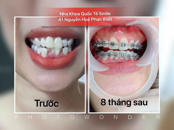 Không gian điều trị tiêu chuẩn quốc tế tại Nha Khoa Quốc Tế Smile